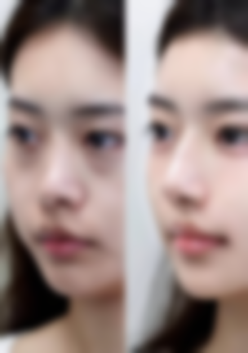 割双眼皮痕迹修复：正规医院推荐