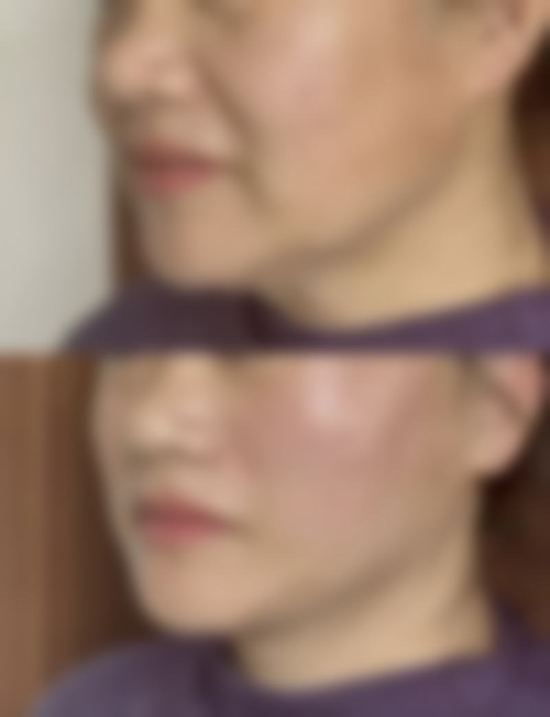 割双眼皮后多久备孕合适？3 - 6 个月综合考量，保障母婴与术后恢复双安心 