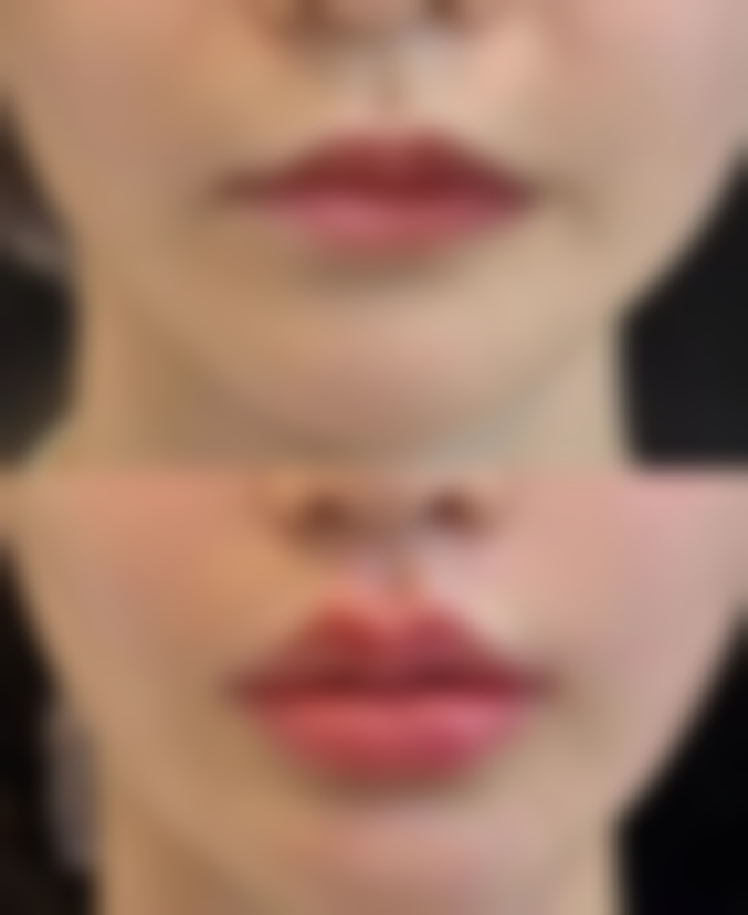 疤痕疙瘩虽棘手，治疗方案多样化