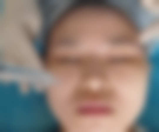 当场见效！术后状态直接封神，果断续5次