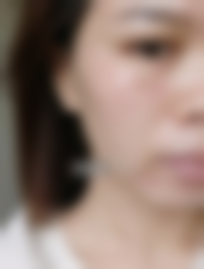 术后成效+半个月跟踪，真的没复发！