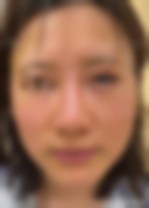 郝劲伟医生异物生长因子取出怎么样可靠吗？