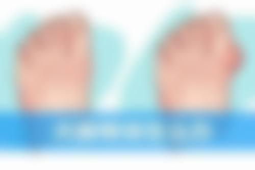 割双眼皮肉条形成原因之术后护理因素