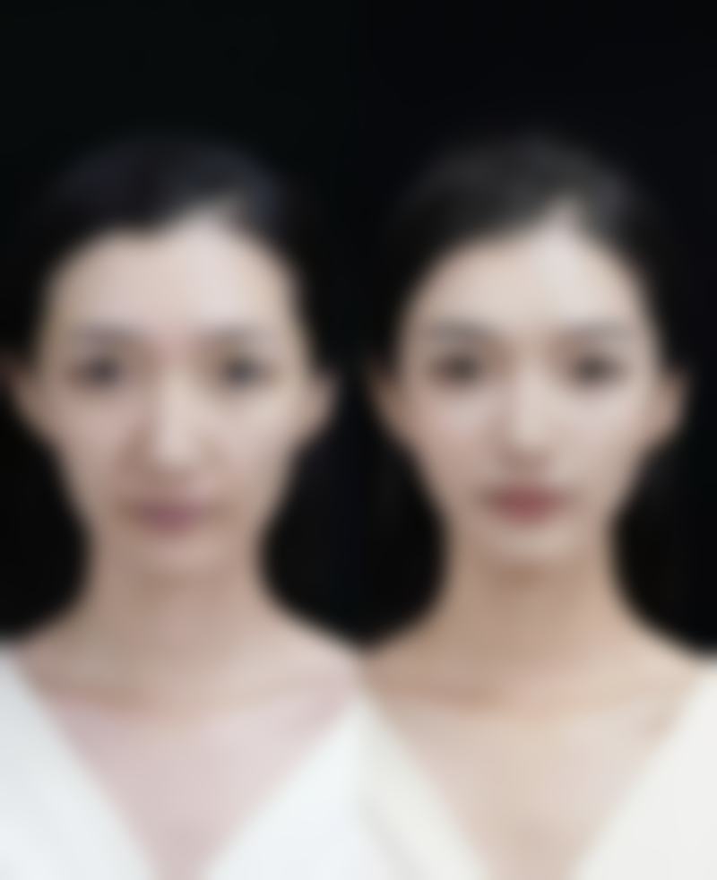 刚出生能割双眼皮吗？不同年龄段眼部发育特点