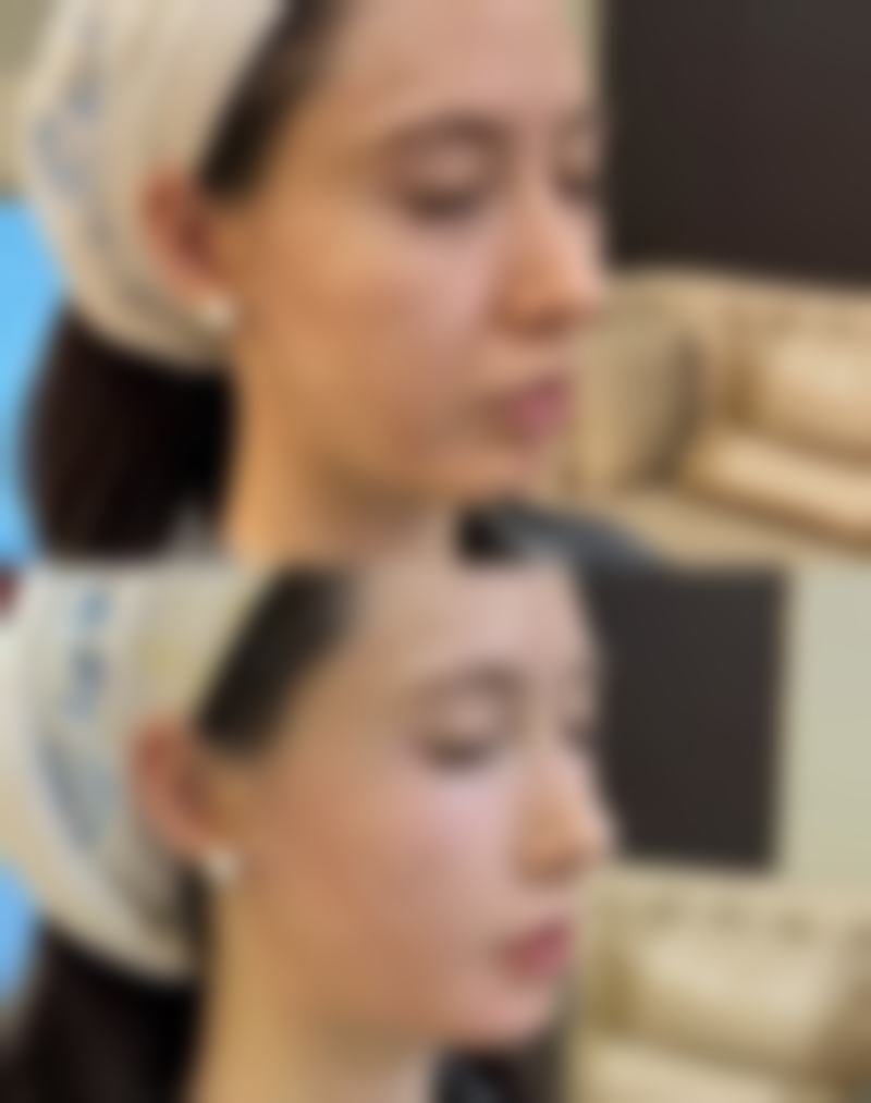 割双眼皮肉条形成原因之肿胀因素