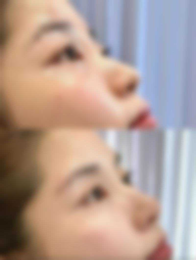 刚出生能割双眼皮吗？了解手术风险与最佳时机，给孩子安全变美保障 