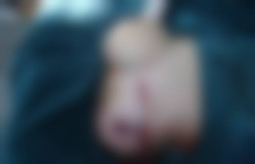 全身抽脂如何操作？——手术中的具体流程