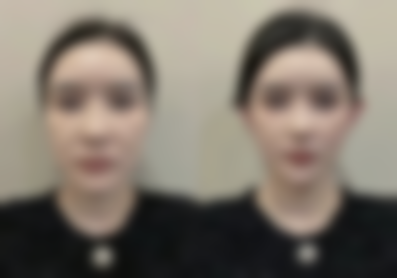 邓东医生面部提升怎么样可靠吗？