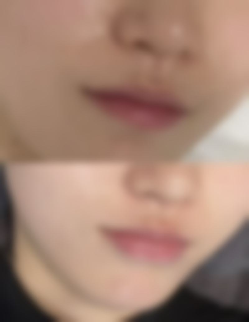 瘢痕增生加重：美丽眼睛留下遗憾印记