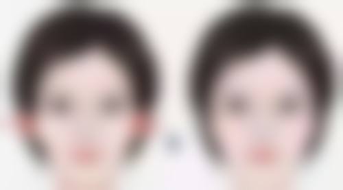 如何降低割双眼皮和开眼角后遗症的风险