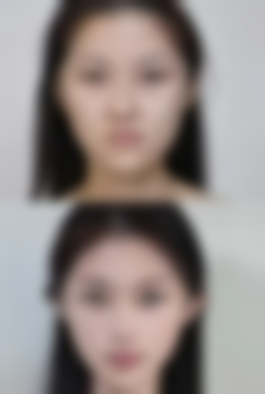 双眼皮手术后吃芒果，补充营养身体棒