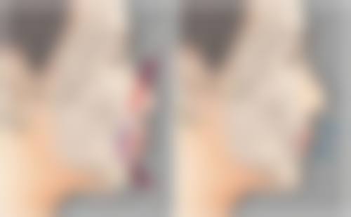 切开双眼皮太宽别愁，多样修复方法任你选