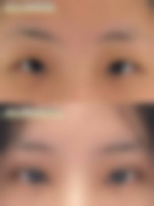 桂行军 医生眼部整形实例