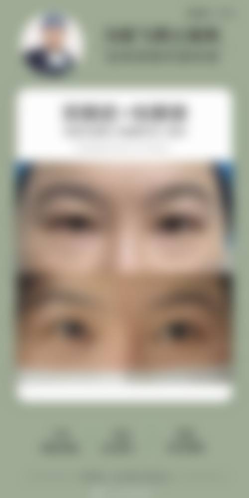 王潇健医生眼部整形实例