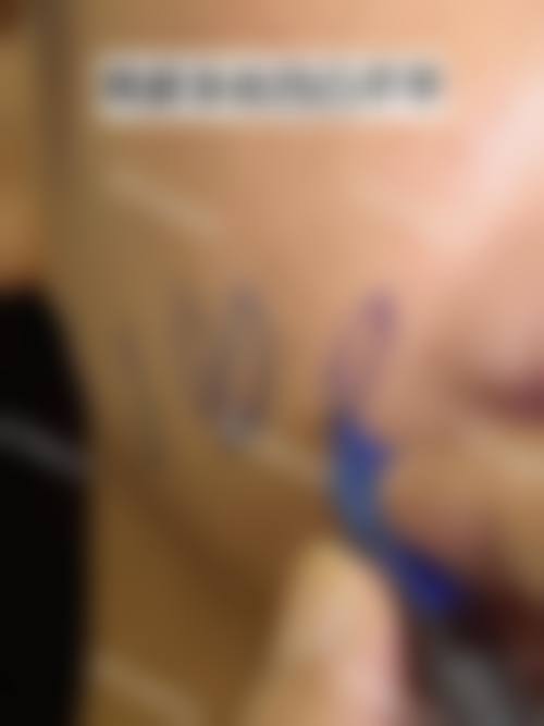 崔努医生直腿术实例