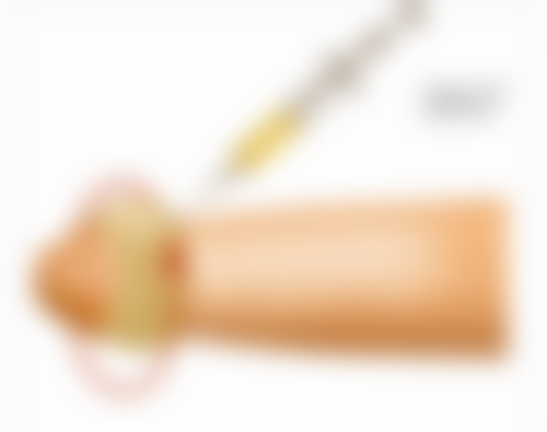 用牙签划出双眼皮究竟需坚持多久？长期坚持或能让双眼皮效果长久保持 