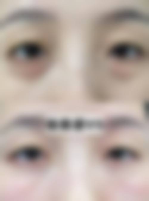 王潇健医生眼部整形实例