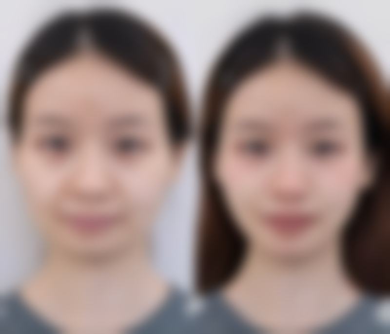 糖皮质激素，影响成效要避开