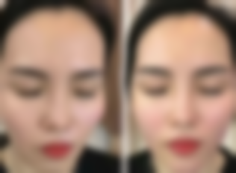 五、宁波慈溪阳明整形医院实例