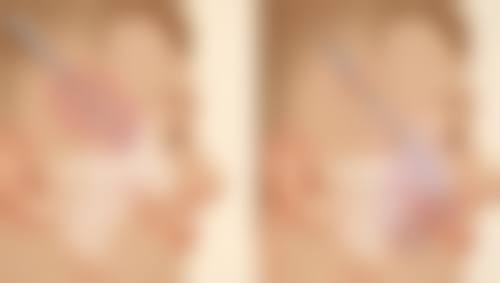 全切双眼皮疤痕修复有妙招,正规产品来助力