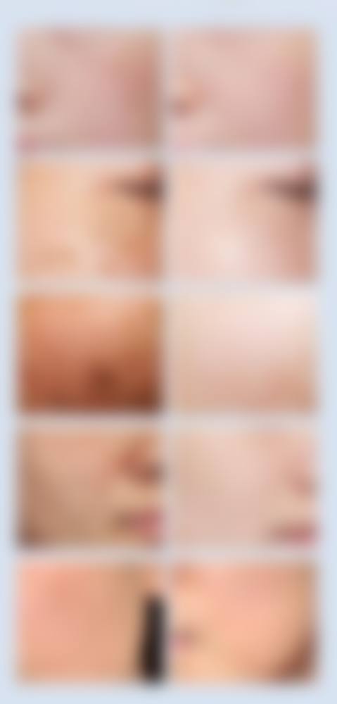 邹灵灵医生激光祛斑怎么样可靠吗？