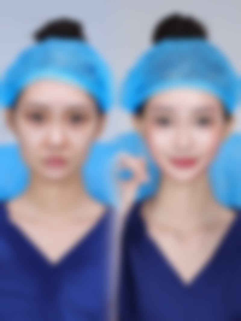 哪种方法做下巴整形好？揭秘创伤小、恢复快且效果自然持久的优质下巴整形法 