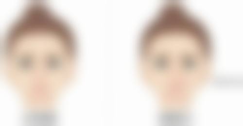 眼部抽脂费用，合理范围可接受