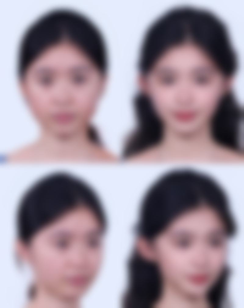 展示全切双眼皮典型修复实例：真实见证快速消肿