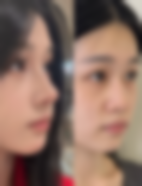 抽脂富贵包暗藏哪些隐患？优势也不能忽视