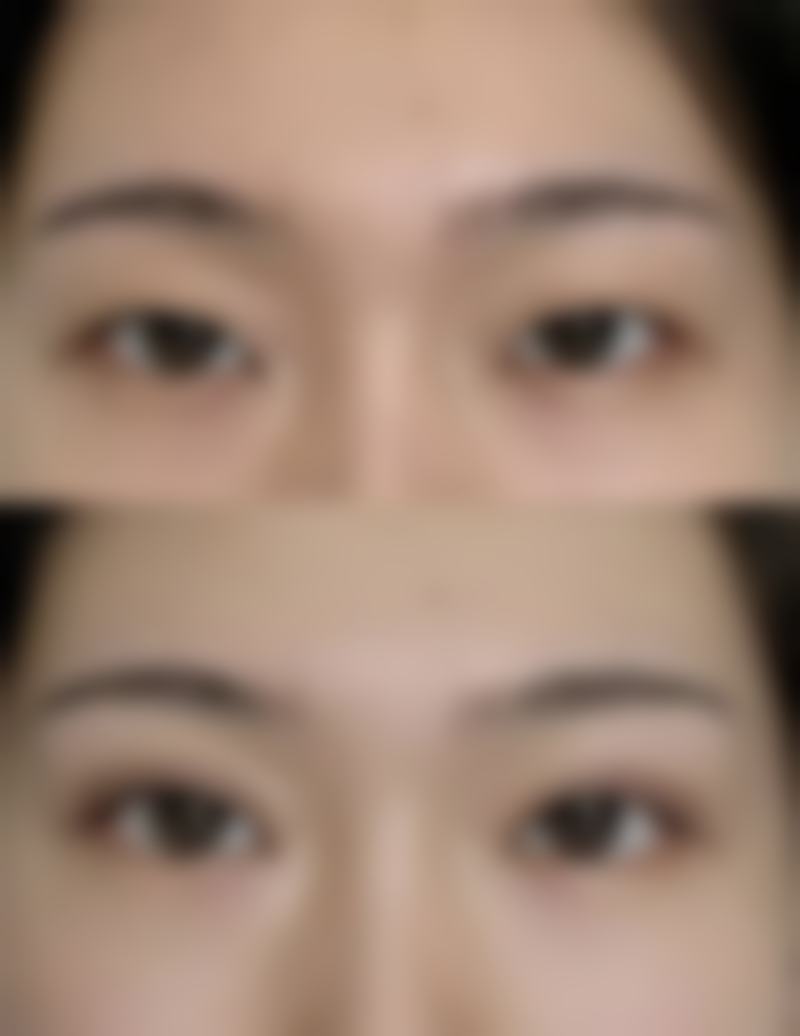 总结全切双眼皮消肿优势：1 - 3个月拥有明亮双眸