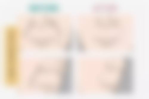 双眼皮增生用疤克：注意事项不能忘