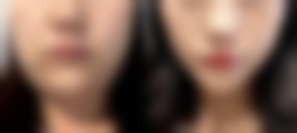 核心治疗方法大揭秘：多种手段助你淡化疤痕