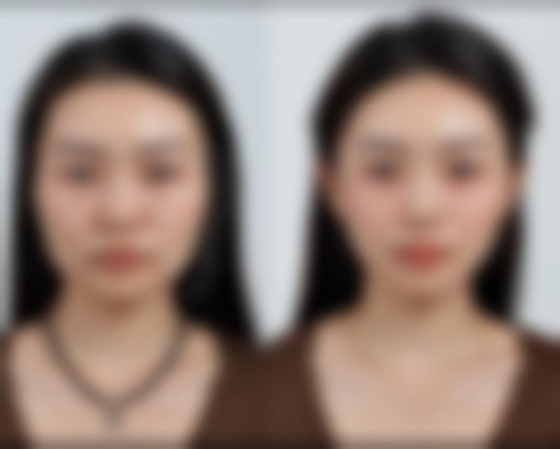 双眼皮增生用疤克：联合治疗更有效