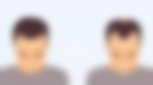 哪种方法去除眼袋更有效？医美手段来助力