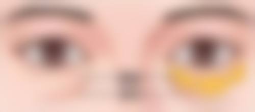 耳软骨隆鼻取出后的修复周期有多长？