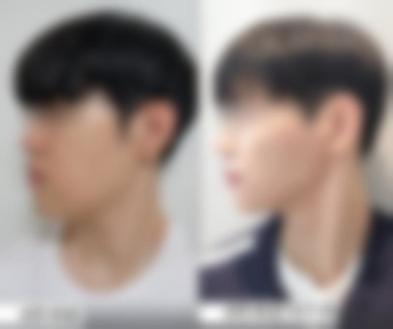 怎样才能快速消除眼袋？医美非手术治疗显神通