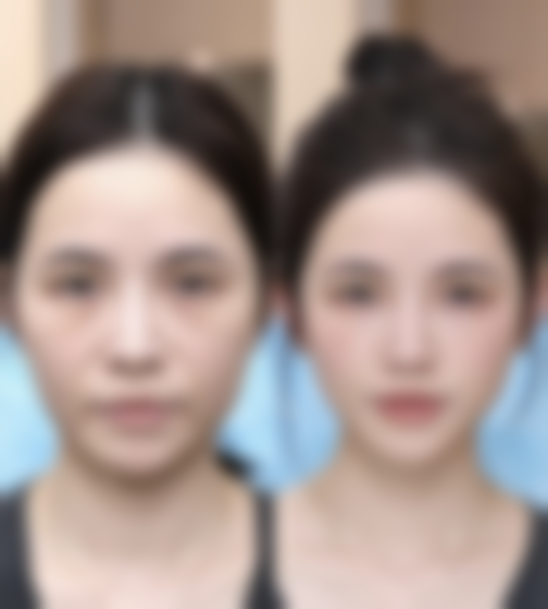 怎样才能快速消除眼袋？手术治疗见真章