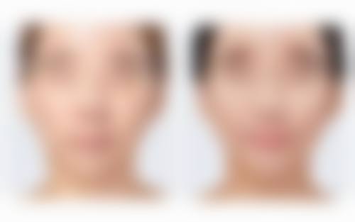 选对方法规避潜在问题，让双眼皮埋线更安心