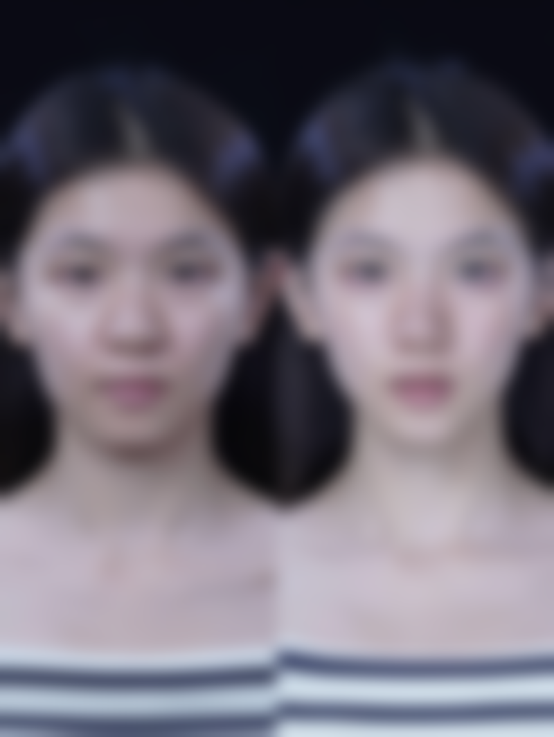 半肋骨隆鼻子效果能否永久？揭秘影响持久度因素及延长效果的实用秘诀 