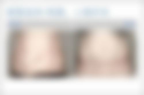 隆鼻多久能消肿？影响消肿时间的核心因素分析