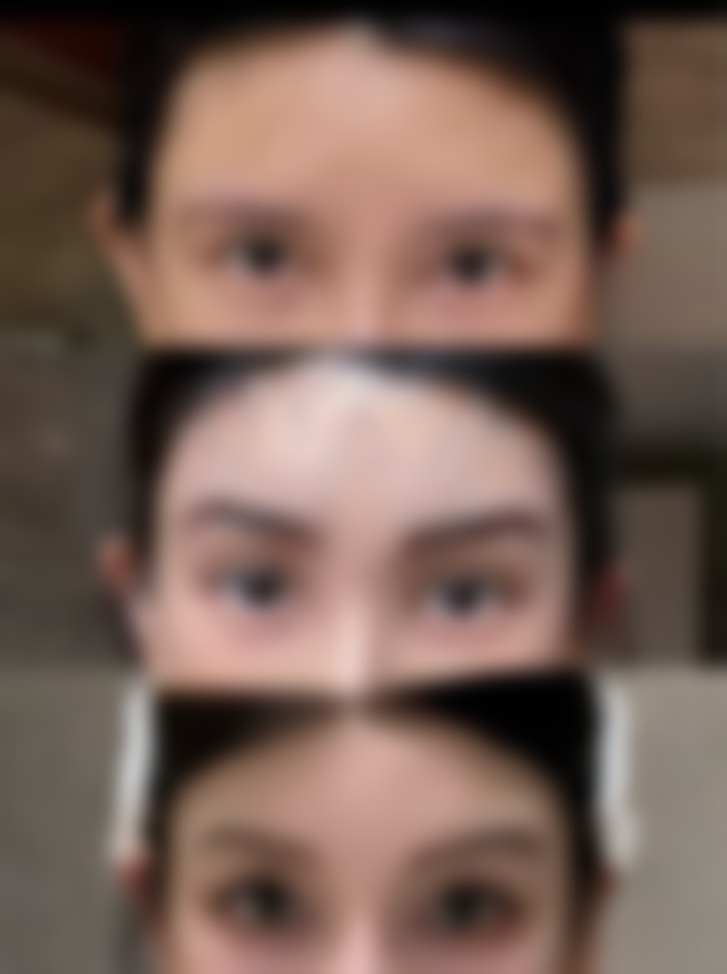 隆胸手术时间究竟几何？不同术式、恢复阶段时长揭秘及影响因素大公开 