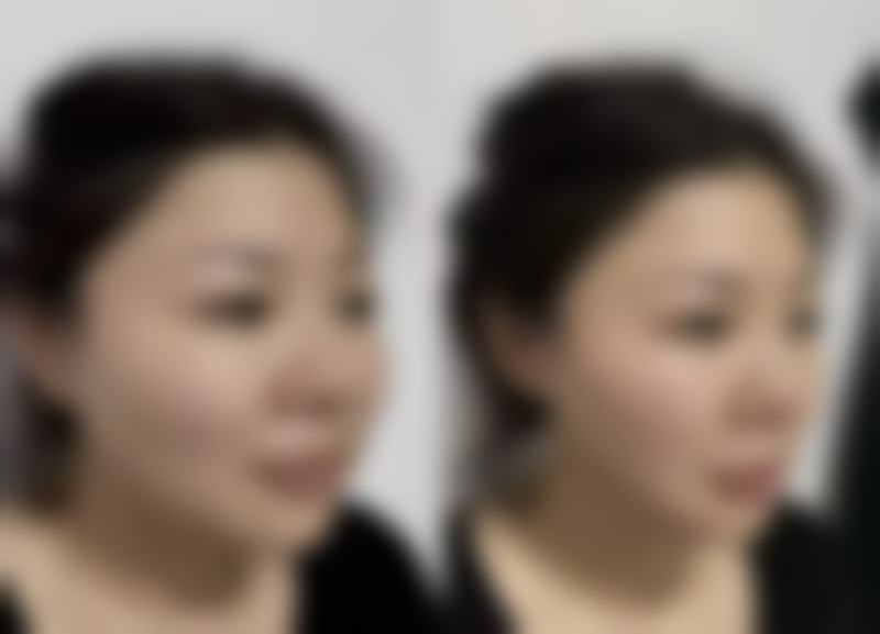 注射胶原蛋白隆鼻成效怎样？术后护理要做好