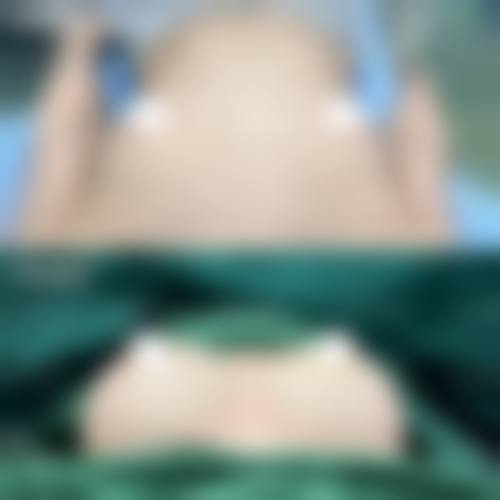 五、中南大学湘雅二医院烧伤整形外科实例