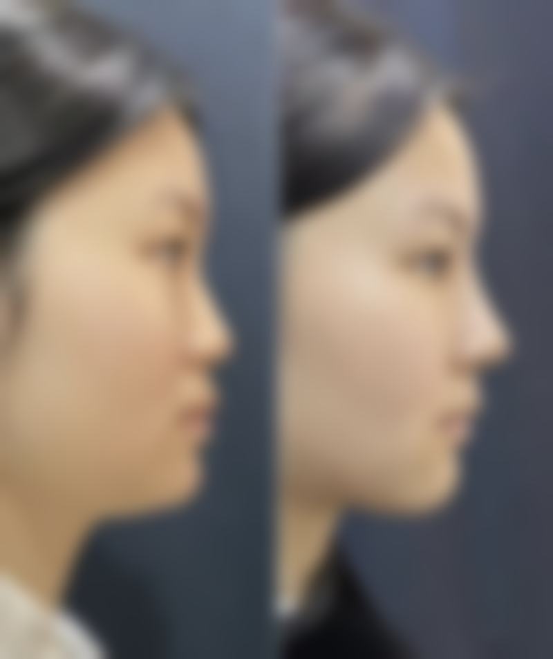 隆鼻手术材料大盘点:其他材料的特点