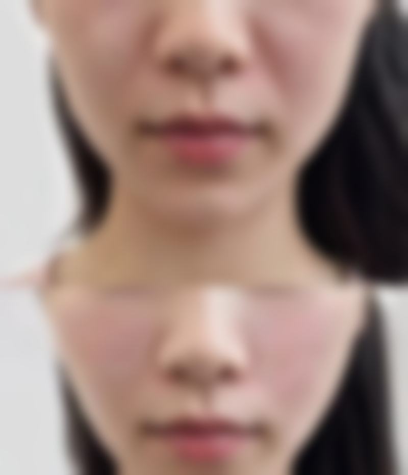 隆鼻手术材料大盘点:材料选择与术后护理