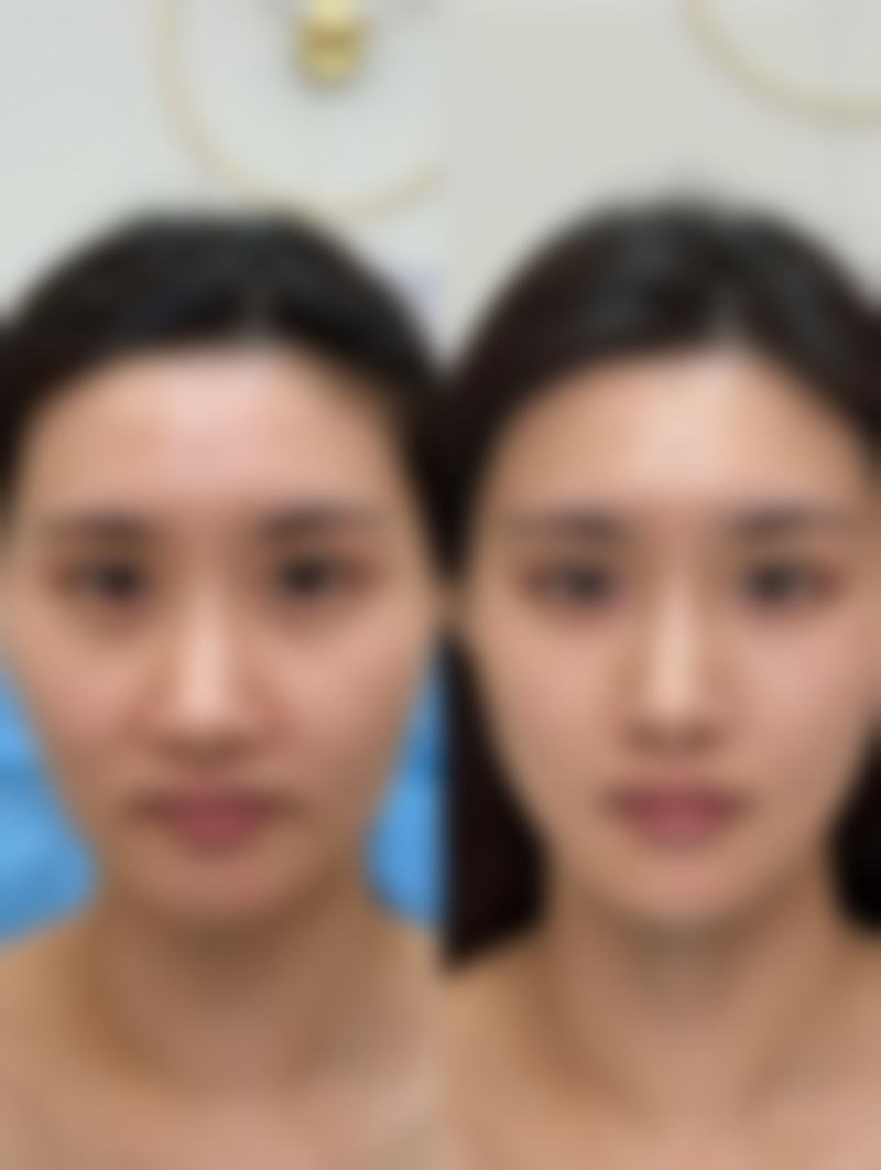 切眼袋修复周期：完全修复期