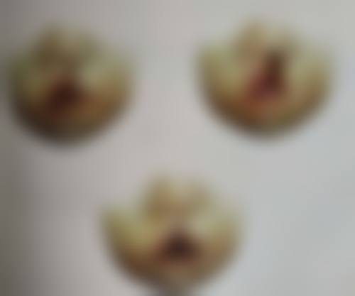 小腿抽脂暗藏哪些风险与后遗症？揭秘感染、不对称等问题及应对之法 