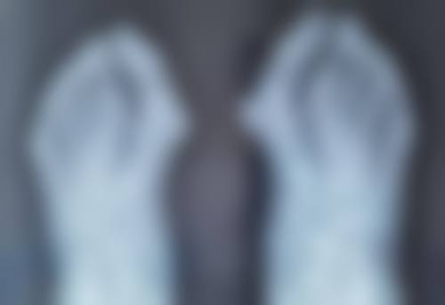 疤痕体质的疤痕去除难题怎么破？激光治疗重塑肌肤外观