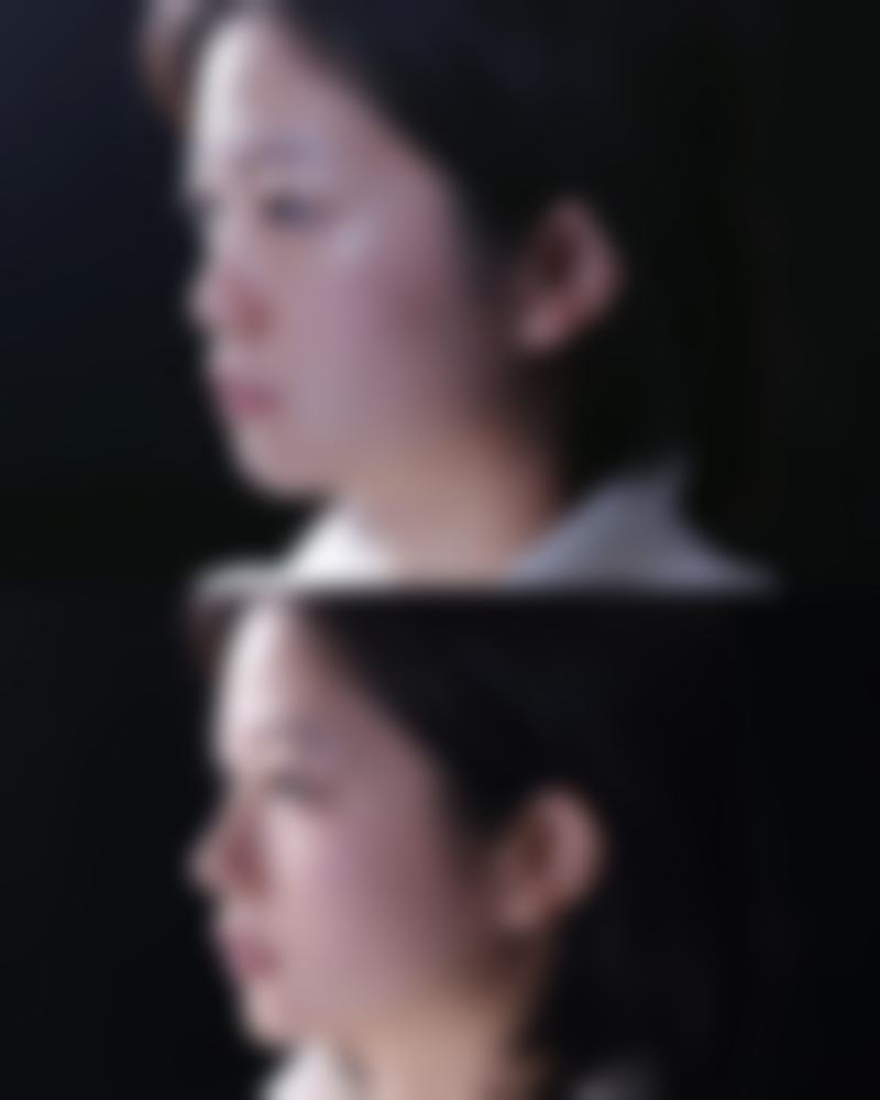 红色凹陷疤痕消除攻略：激光治疗显神通