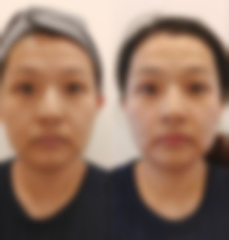 消除红色凹陷疤痕大揭秘：外用药物修复法